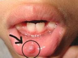 Symptoms of Lip Cancer   How to recognize them   Acikgunluk