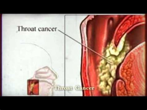 Symptoms of Throat Cancer   YouTube