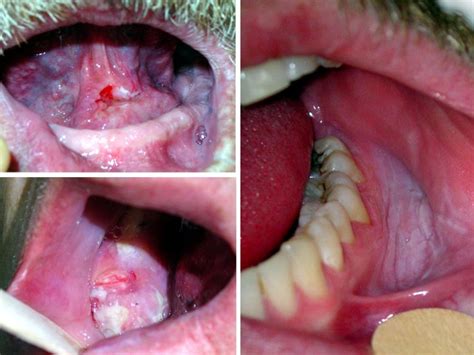 Symptoms: Oral Cancer Symptoms