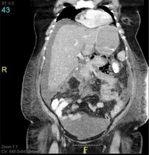 TAC de abdomen con contraste iv, que documenta necrosis de ...