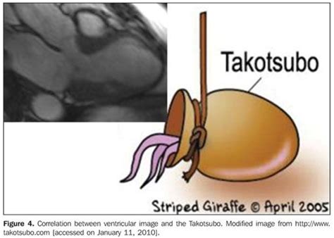 Takotsubo Cardiomyopathy   Octopus trap... or broken ...