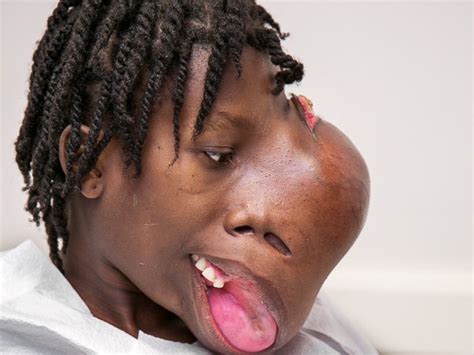 Teenager  Happy  After 4 Pound Facial Tumor Removed ...