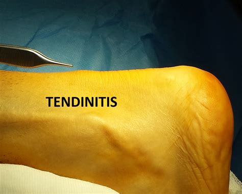 Tendinitis del Tendón de Aquiles | Blog Dr. Sami Val