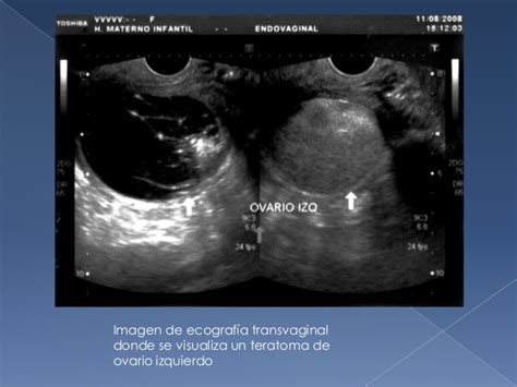 Teratoma ovarico