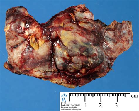 Teratoma   Pictures