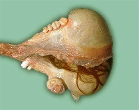 Teratoma   Pictures, Symptoms, Causes and Treatment
