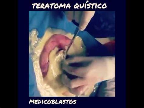 Teratoma Quístico.   YouTube