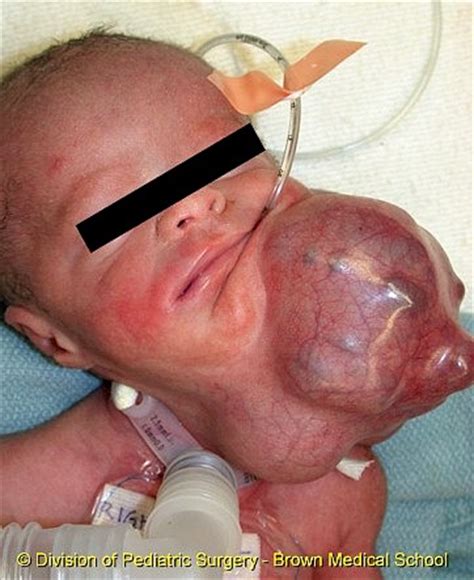 Teratoma With Limbs | www.pixshark.com   Images Galleries ...