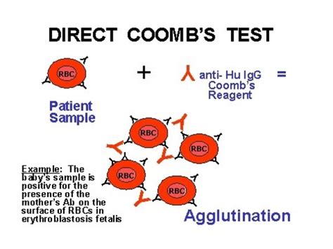 The Coombs  Test | Newborn Nursery | Stanford Medicine