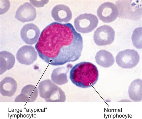 The gallery for   > Atypical Lymphocytes