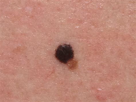 The gallery for   > Early Malignant Melanoma In Situ