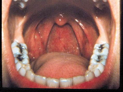 The gallery for   > Hpv On Tongue