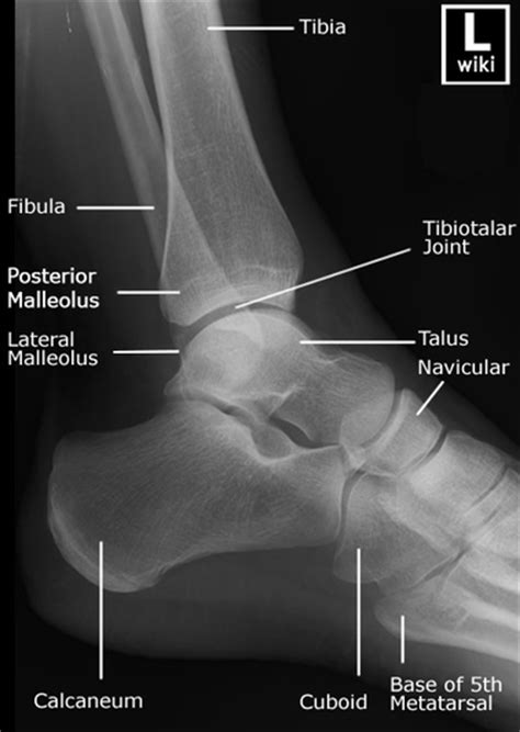 The gallery for   > Lateral Malleolus Avulsion Fracture