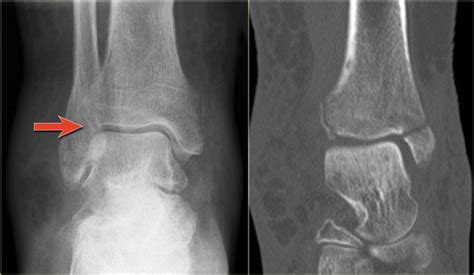 The gallery for   > Lateral Malleolus Avulsion Fracture