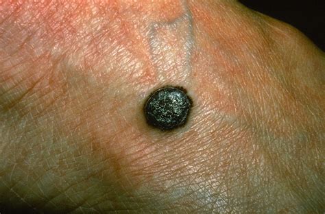 The gallery for   > Nodular Melanoma Symptoms Pictures