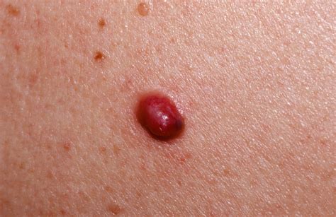 The gallery for   > Nodular Melanoma Symptoms Pictures