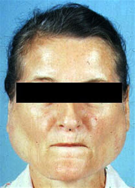 The gallery for   > Parotid Gland Swelling Mumps