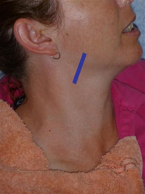 The gallery for   > Swollen Salivary Glands In Neck
