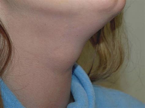 The gallery for   > Throat Cancer Lump In Neck
