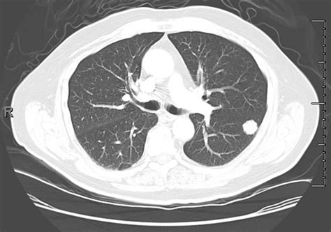 The Lung Nodule That Refused To Grow | AHRQ Patient Safety ...