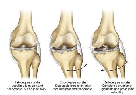 The most common knee injuries and disorders   kneesafe.com