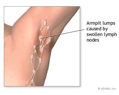 The New York Times > Health > Image > Swollen Lymph Nodes ...