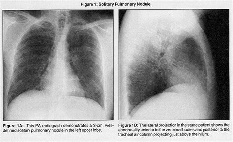 The Radiologic Appearance of Lung Cancer | Physicians Practice