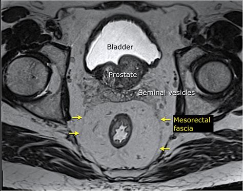 The Radiology Assistant : Rectal Cancer   MR staging 2.0