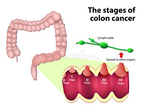 The Stages Of Colorectal Cancer Stock Vector ...