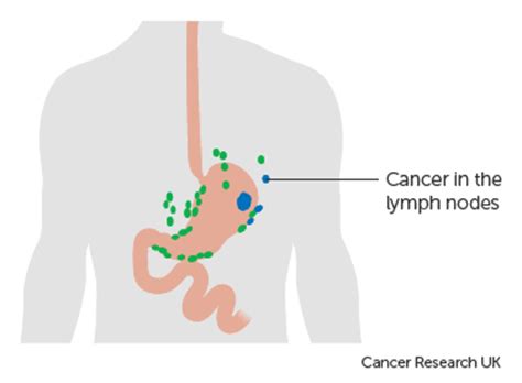 The stages of stomach cancer | Cancer Research UK