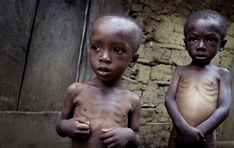 These 10 Countries Starving To Death Will Make You Think ...