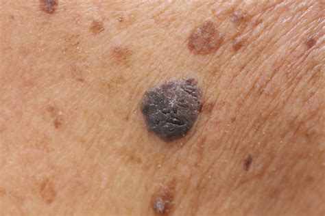 These New Skin Cancer Treatments Unleash Your Immune ...