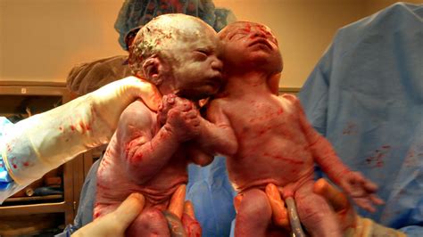They need each other : Twins born holding hands still ...
