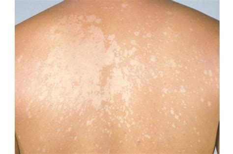 This Skin Fungus Is Super Common And You ll Probably Get ...