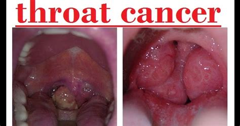 throat cancer info: head and throat cancer