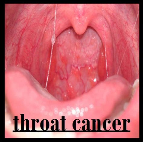 throat cancer info