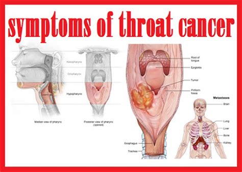 throat cancer info: symptoms of throat cancer