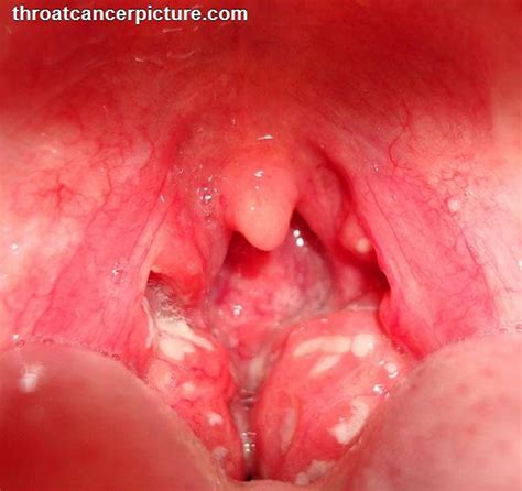 Throat Cancer Symptoms And Signs
