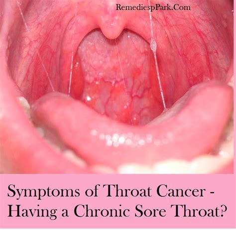 Throat Cancer Symptoms Related Keywords   Throat Cancer ...