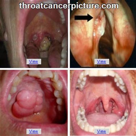 Throat Cancer Symptoms Related Keywords   Throat Cancer ...