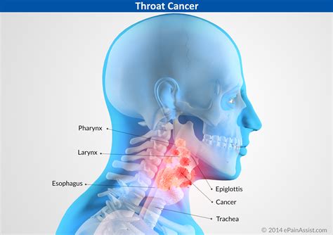 Throat Cancer|Types|Causes|Signs|Symptoms|Treatment ...