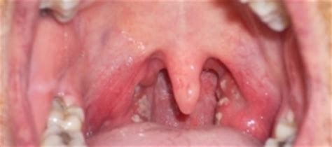 Throat Cancers. Causes, symptoms, treatment Throat Cancers