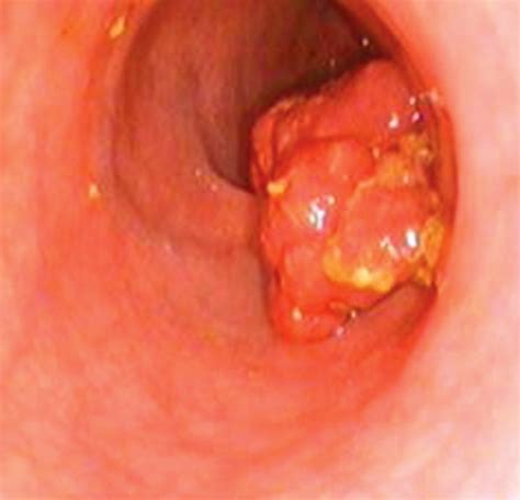 Throat Polyps Pictures, Treatment, Symptoms, Causes