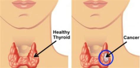 Thyroid Cancer Causes, Symptoms, Diagnosis and Treatment ...