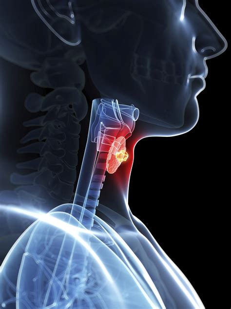 Thyroid Cancer – Am I at Risk? | Continental Hospitals Blog