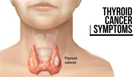 THYROID CANCER SYMPTOMS   YouTube