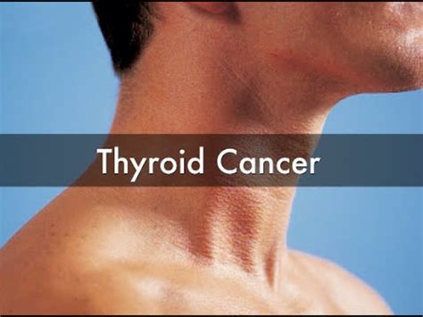 Thyroid Cancer | Thyroid Cancer Symptoms   YouTube