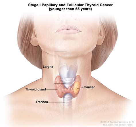 Thyroid Cancer Treatment  PDQ® —Patient Version   National ...