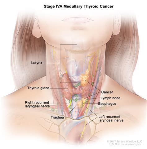 Thyroid Cancer Treatment  PDQ® —Patient Version   National ...