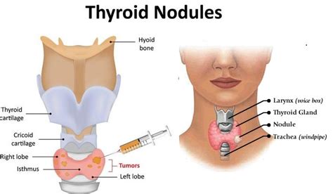 Thyroid Nodules  Size   Causes   Symptoms   Treatments ...